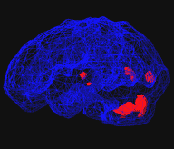 brain-scan-after3