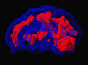 brain-scan-before2b-1